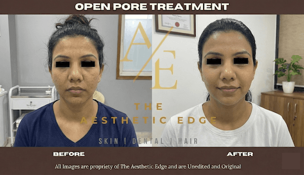 open pore (1)
